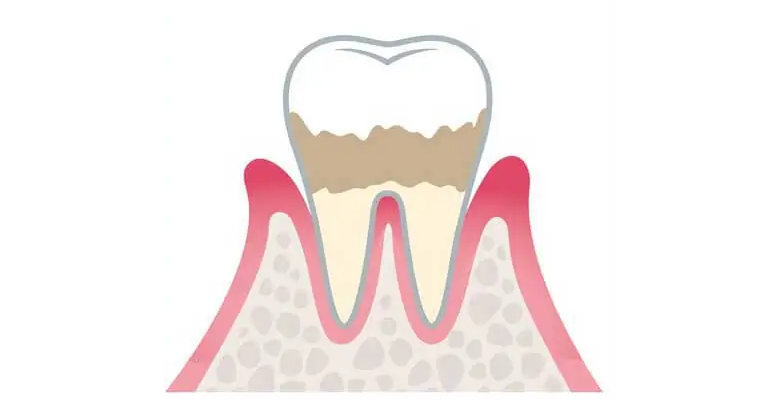 軽度歯周病