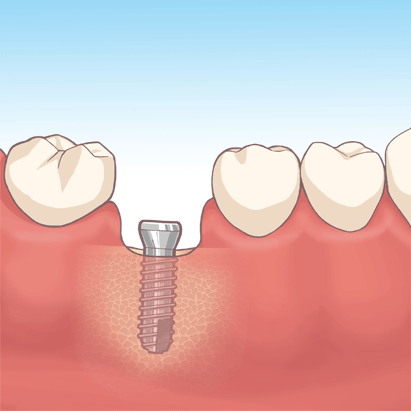 インプラント埋入