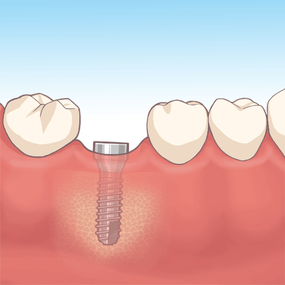 インプラントと骨の結合（治癒期間）