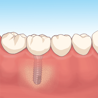 インプラント上に人工歯装着