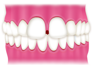 隙間のある前歯（すきっぱ）はどんな歯並び？