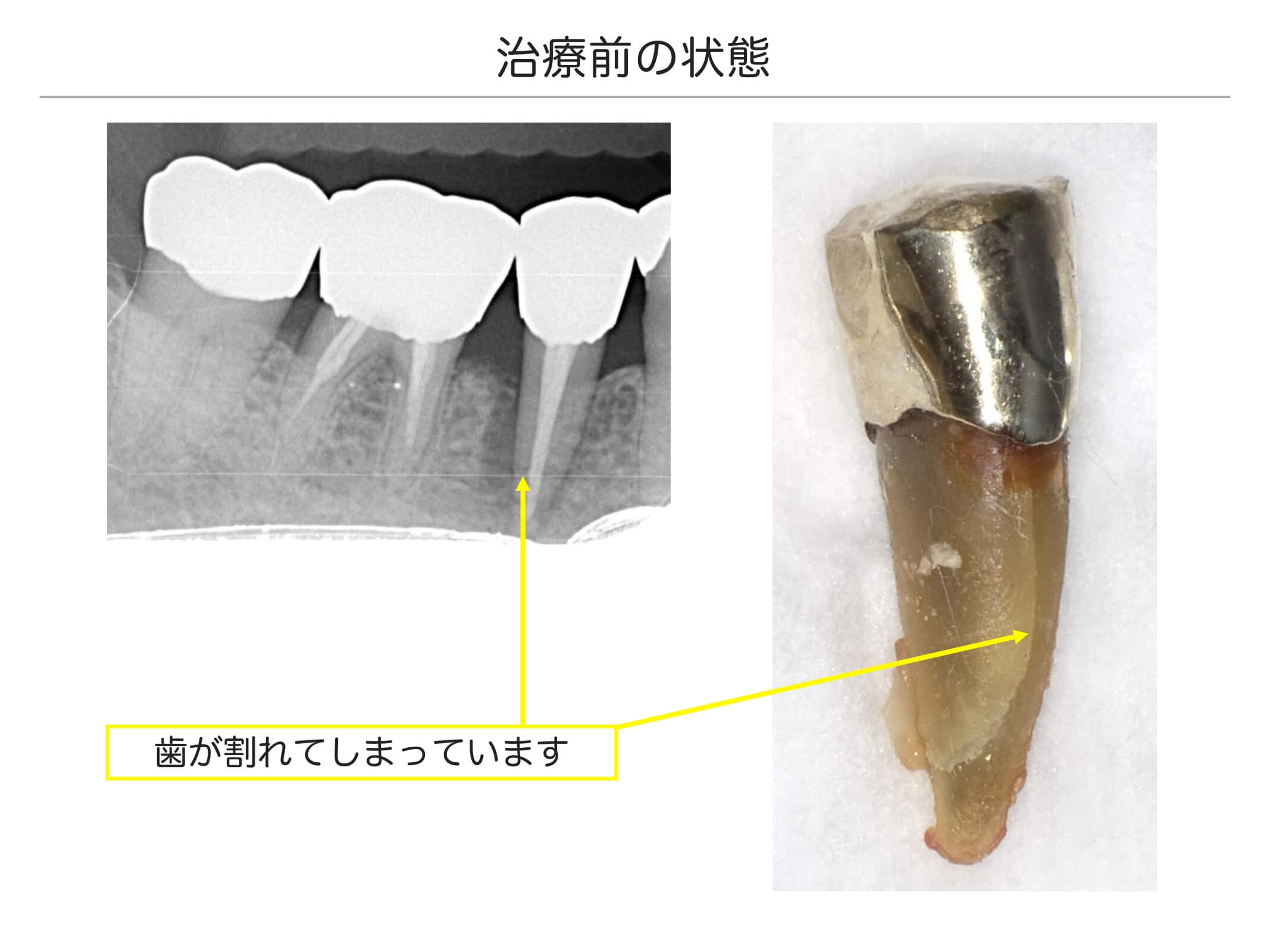 1本の治療例