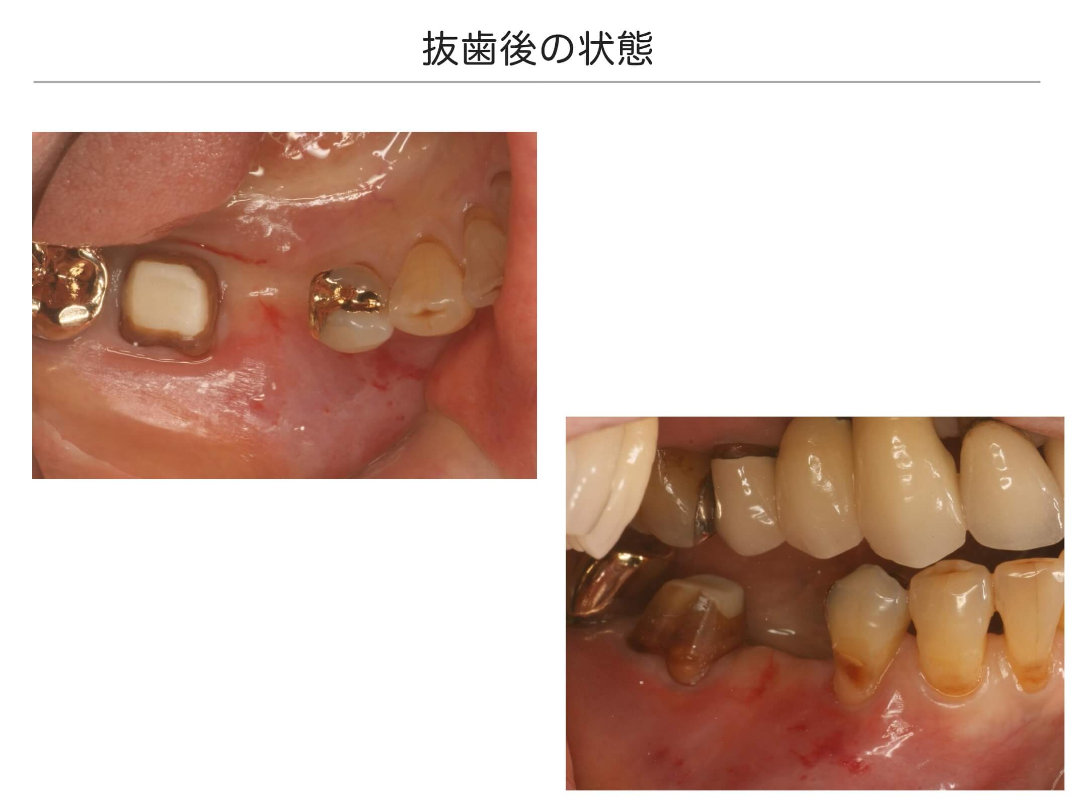 1本の治療例