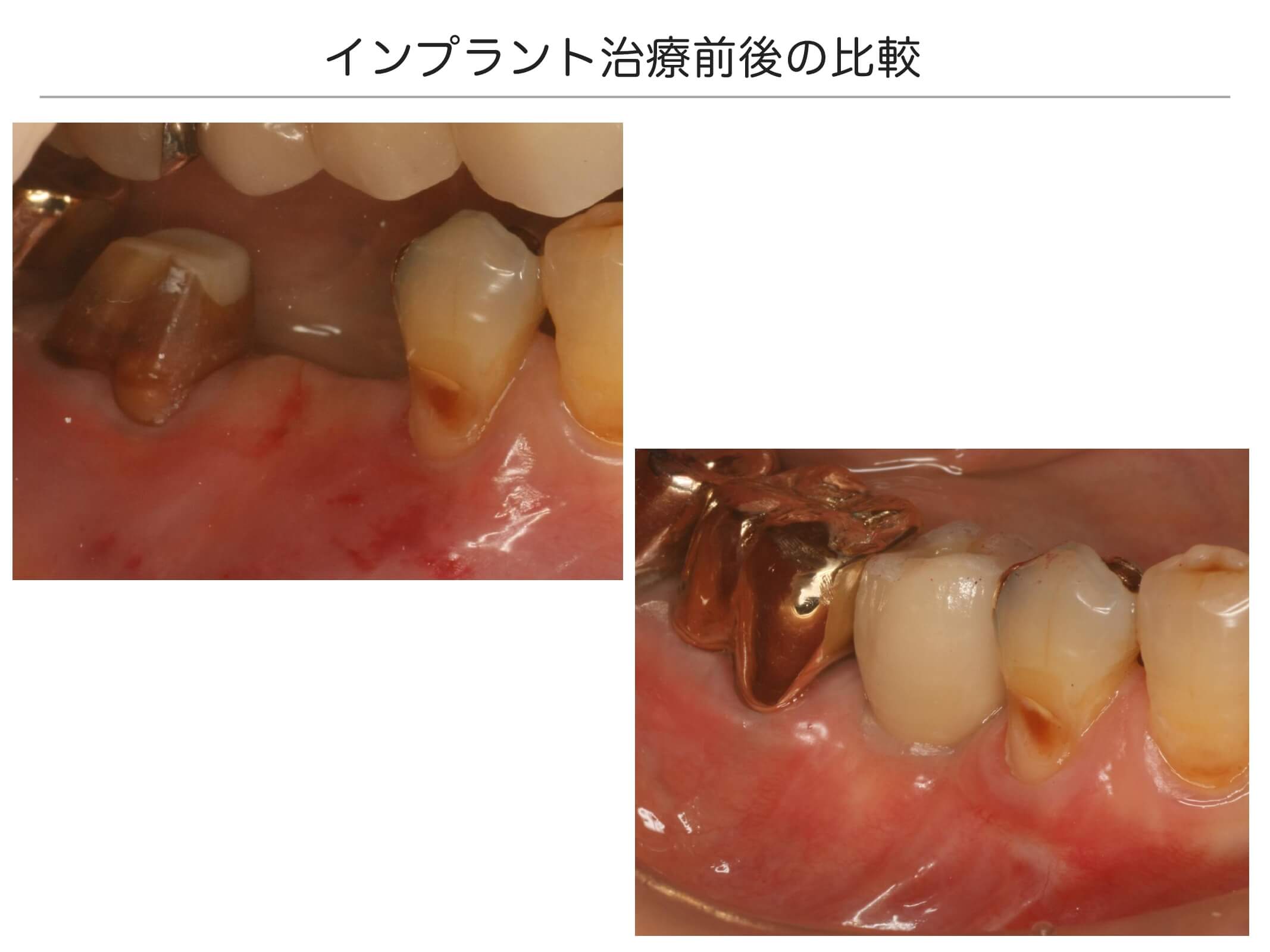 1本の治療例