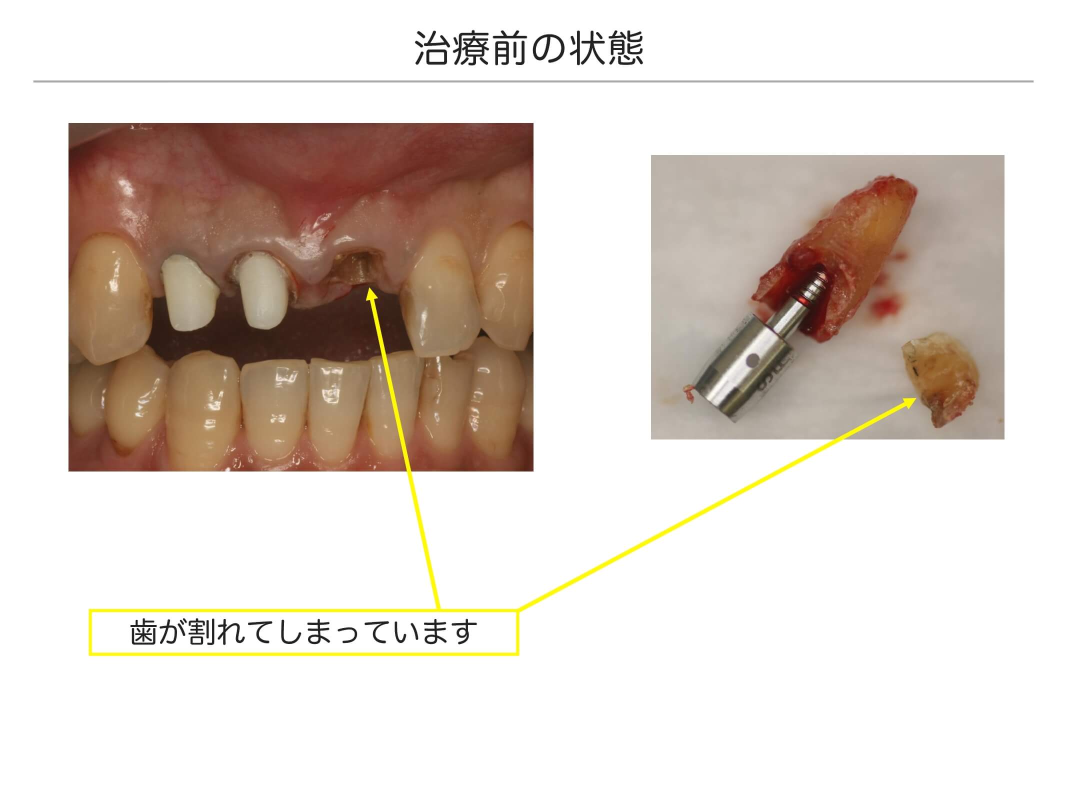 前歯の治療例