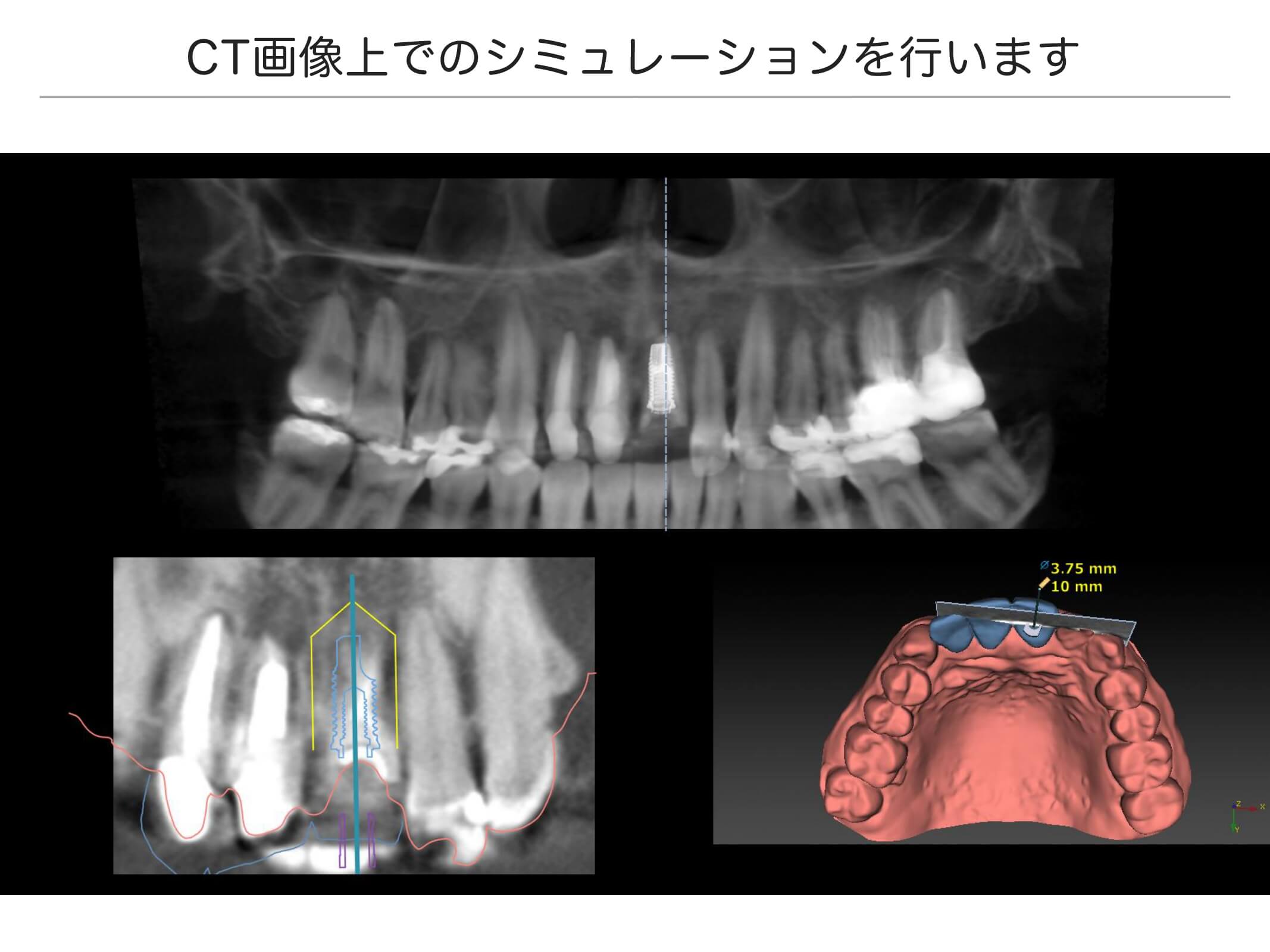 前歯の治療例