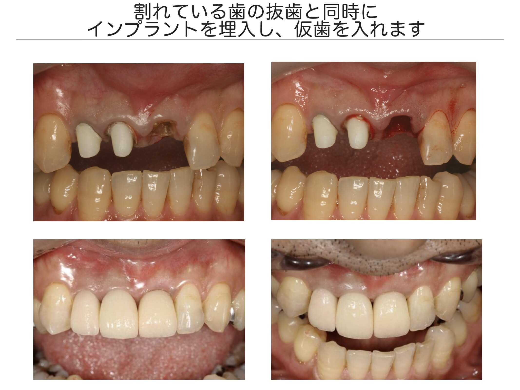 前歯の治療例