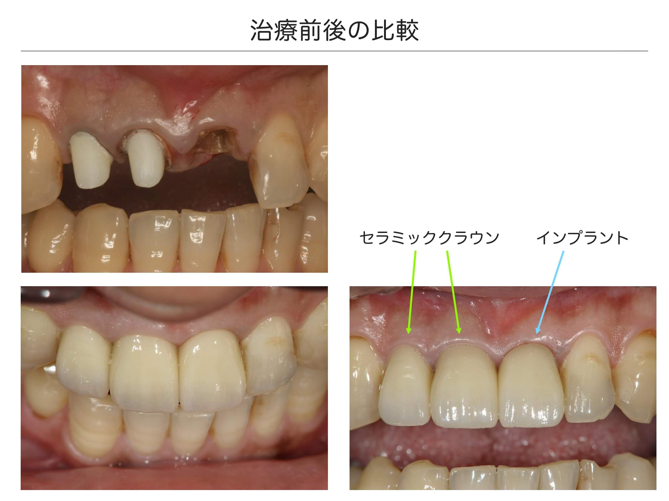 前歯の治療例