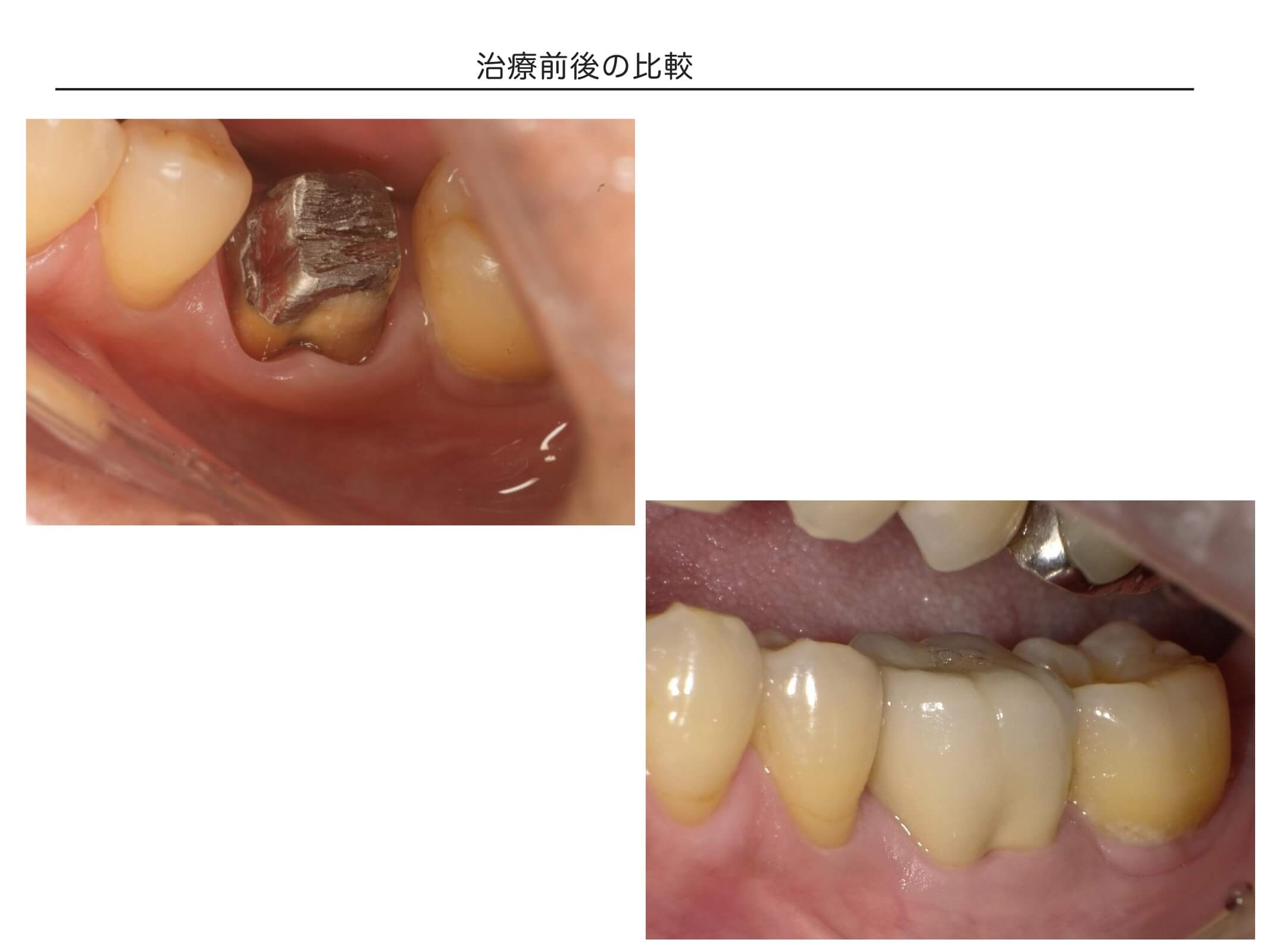 １歯の症例