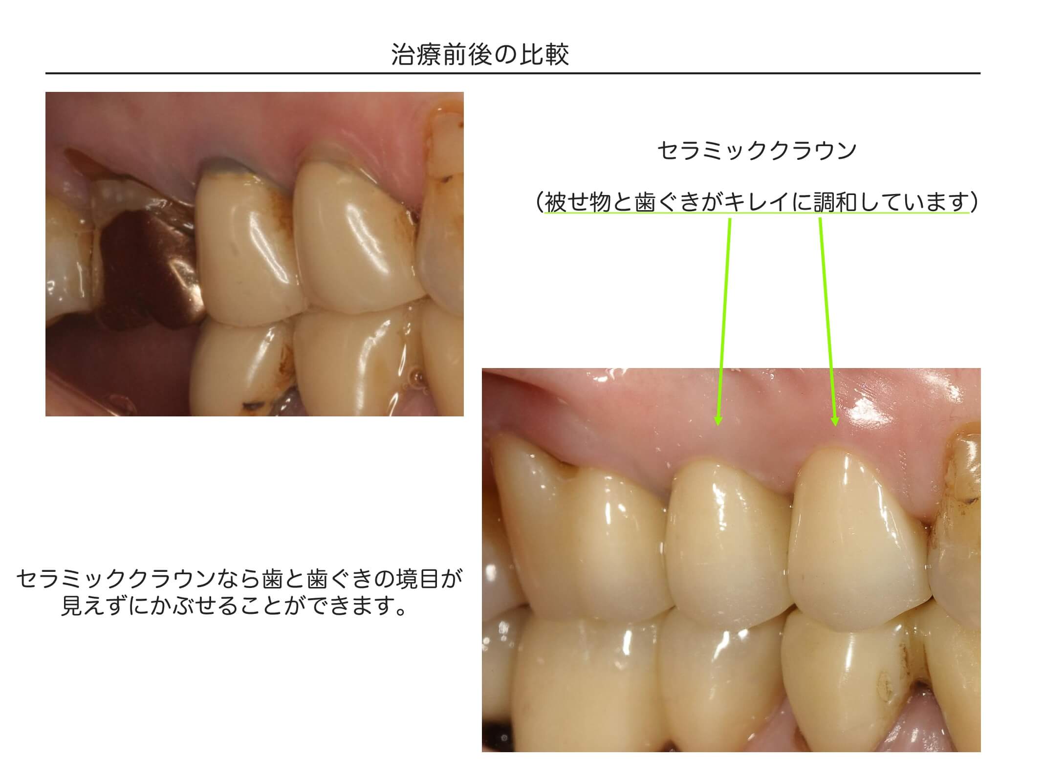 複数歯の症例1
