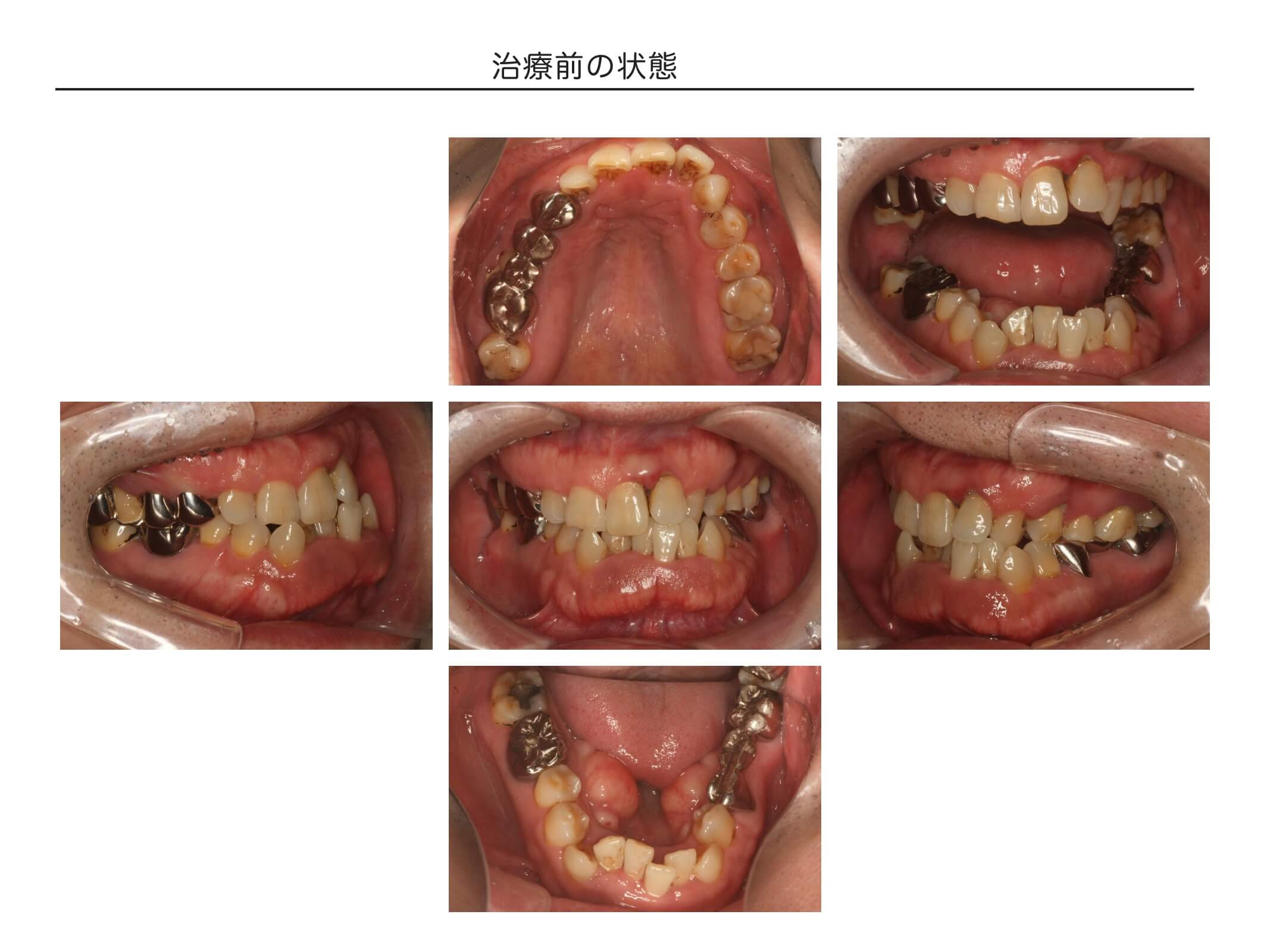 複数歯の症例2