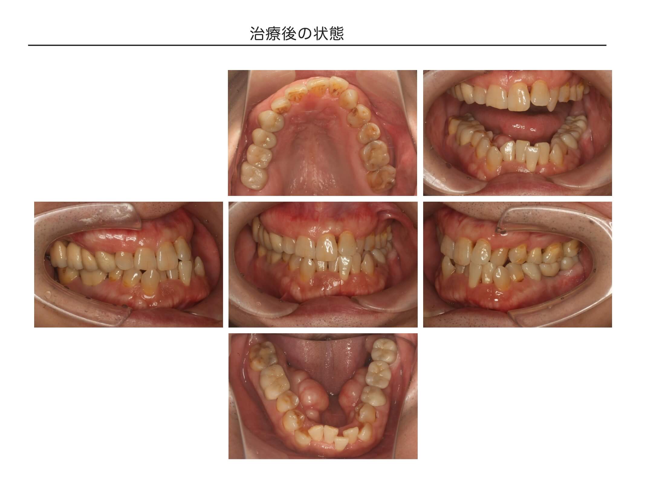 複数歯の症例2