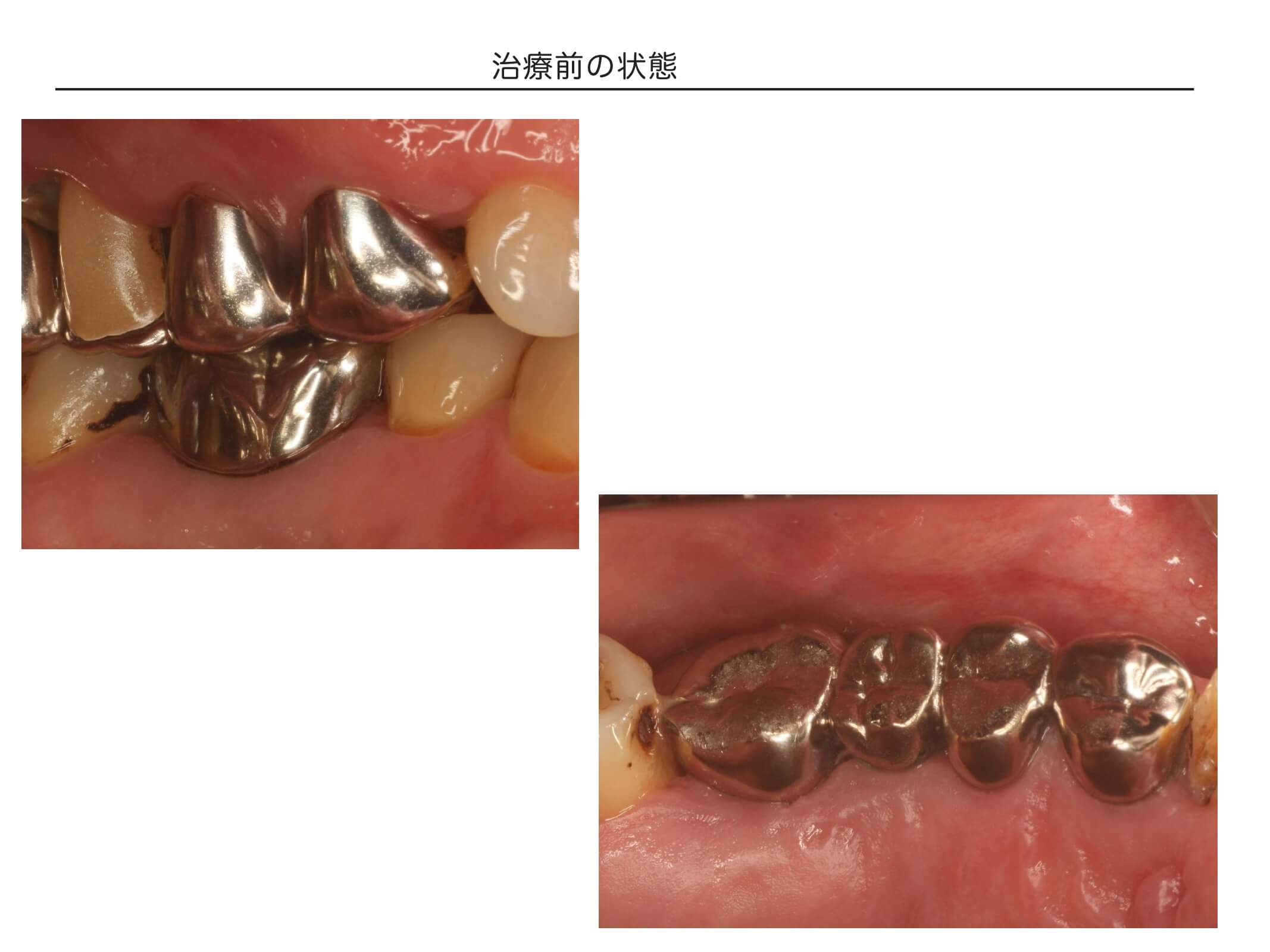 複数歯の症例2