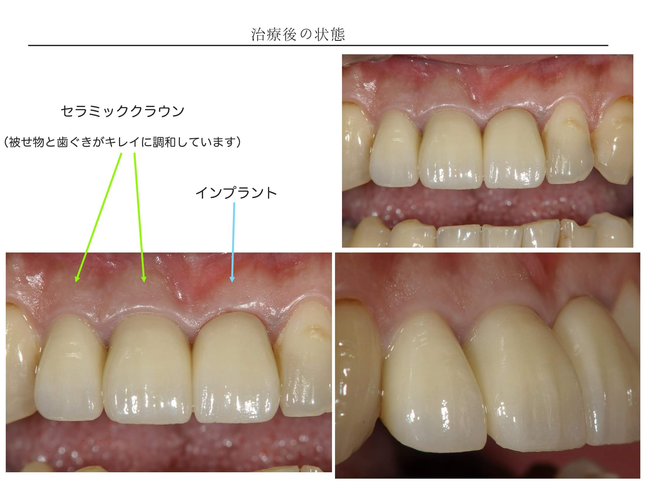 前歯の症例1