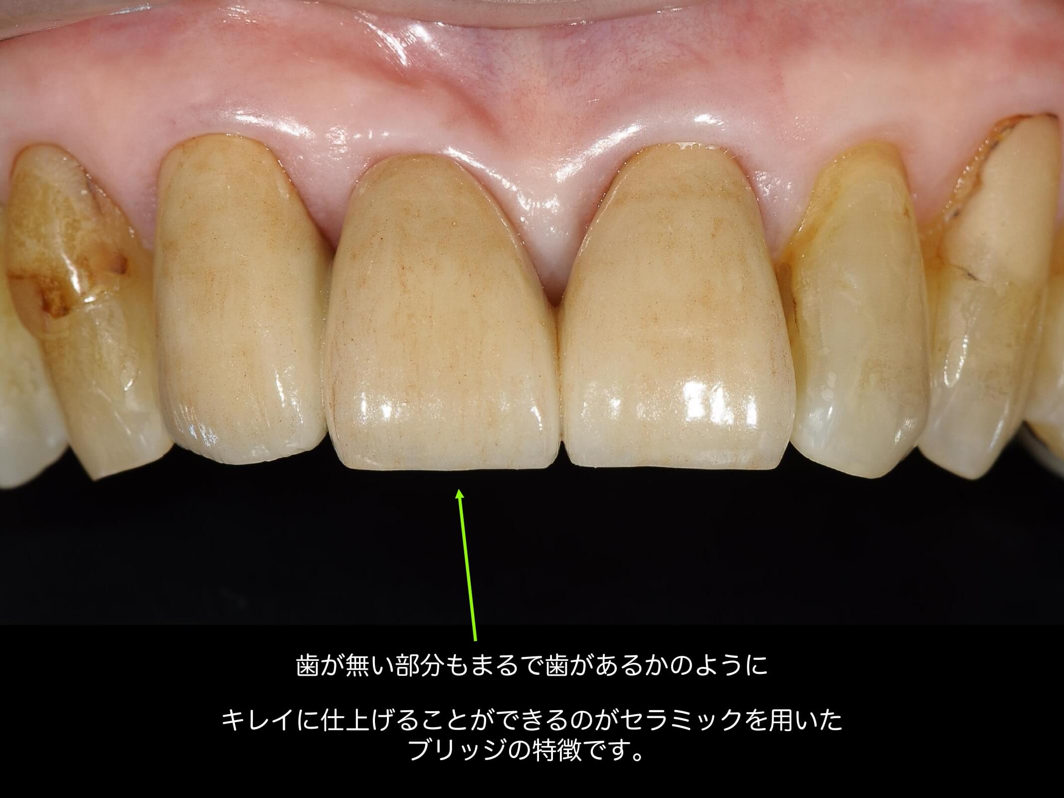 前歯ブリッジの症例２