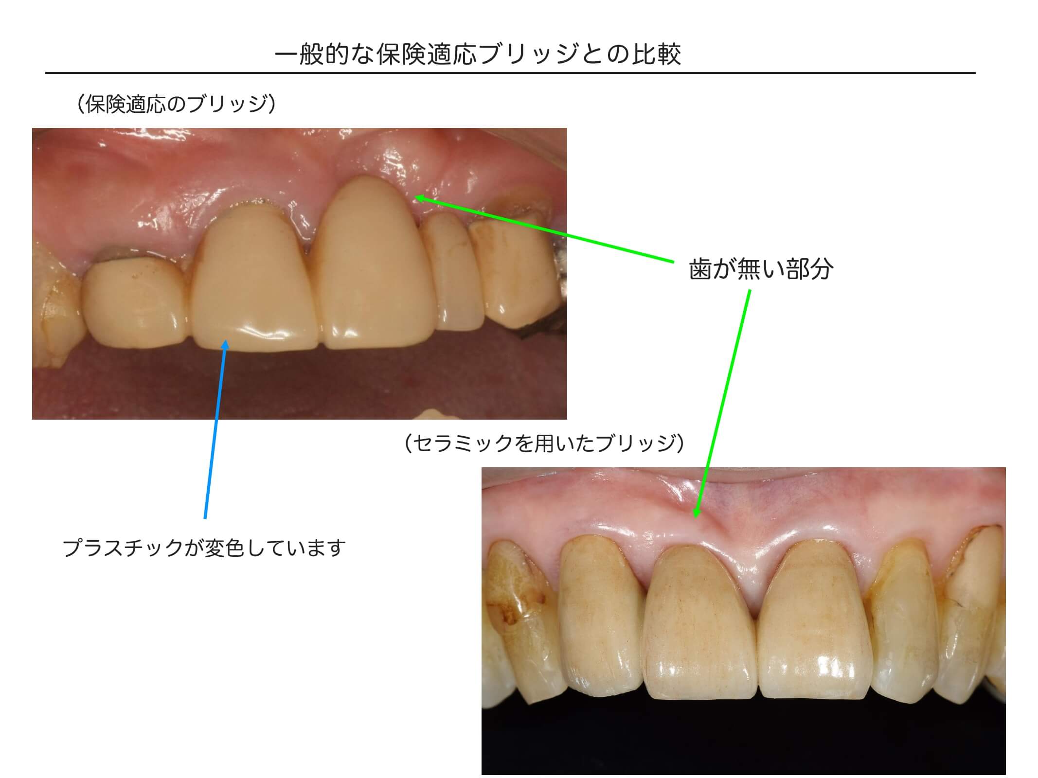 前歯ブリッジの症例２