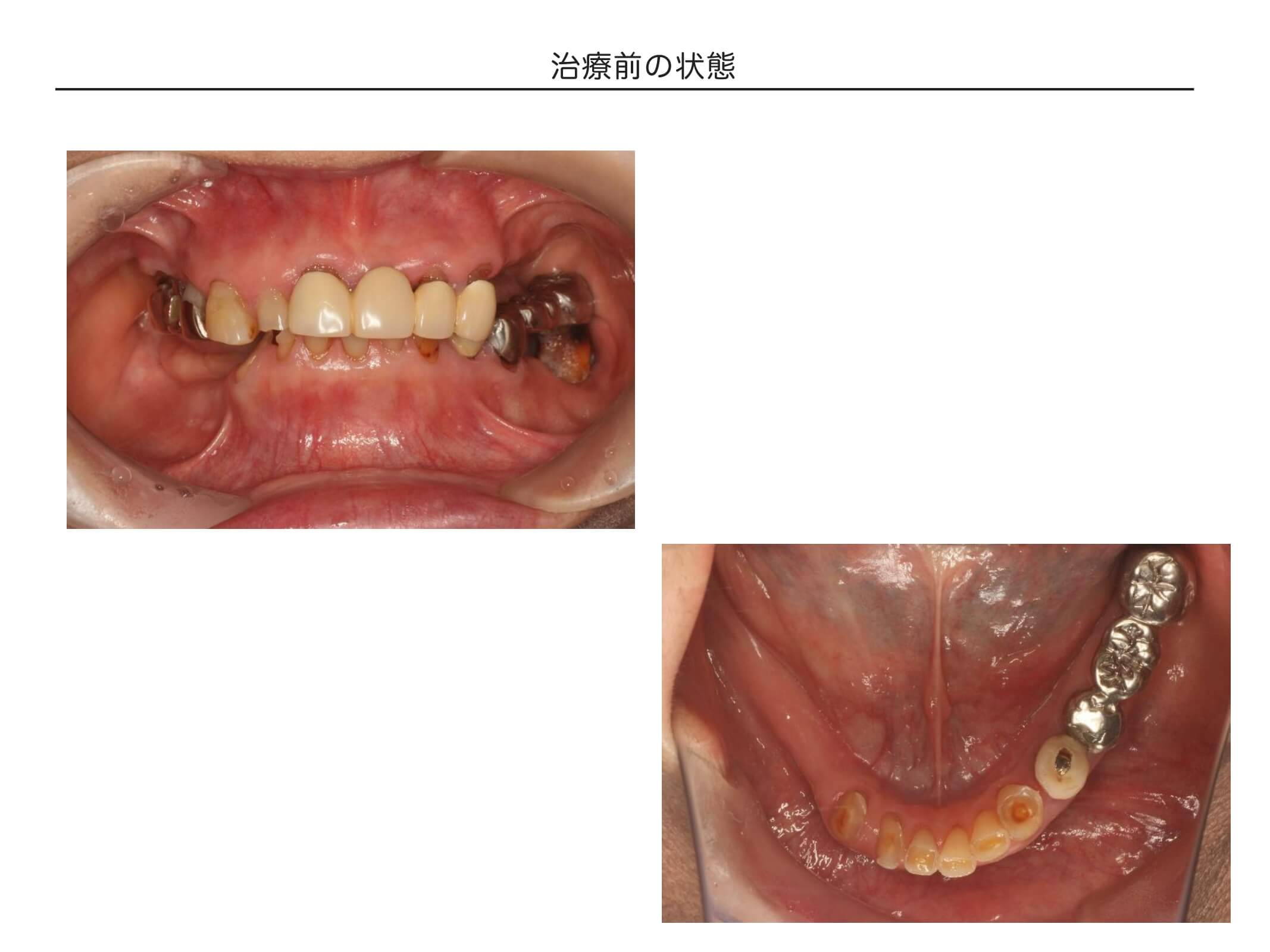 インプラントを含めた全顎治療の症例