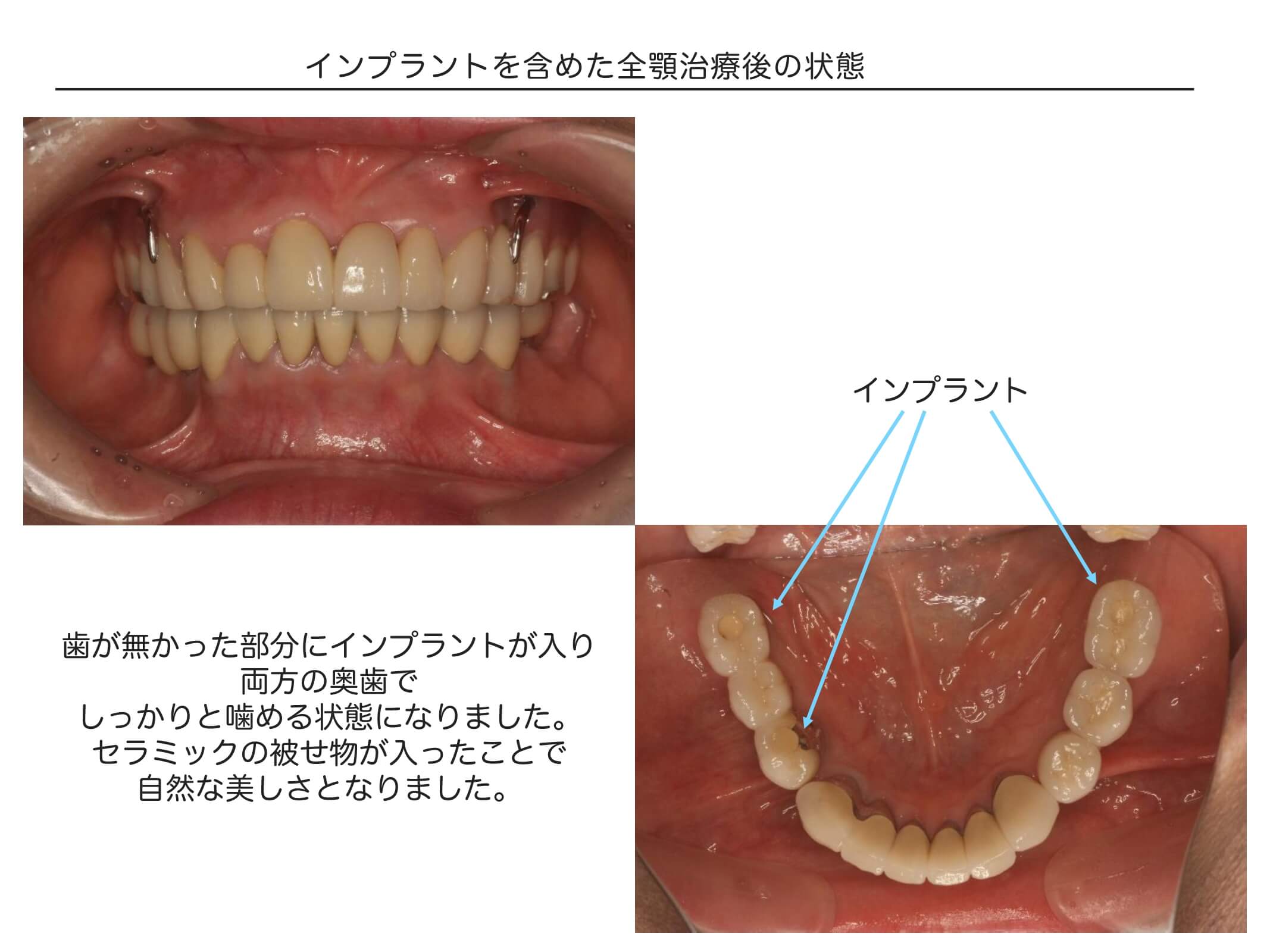 インプラントを含めた全顎治療の症例