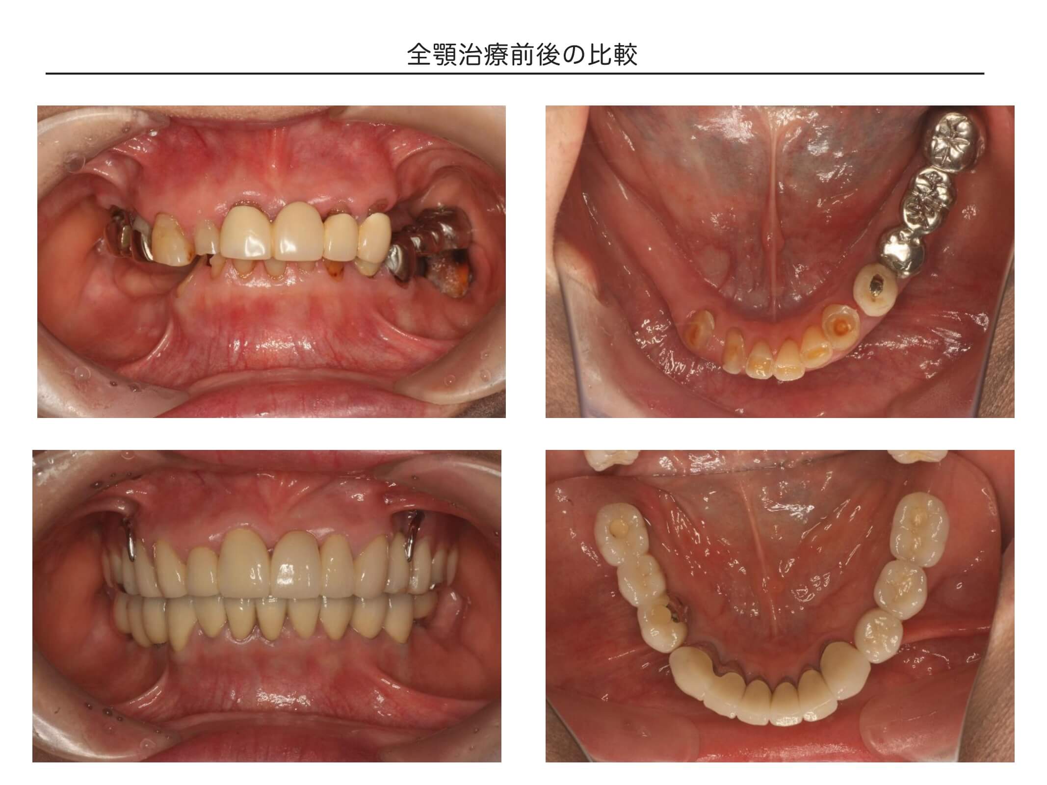 インプラントを含めた全顎治療の症例