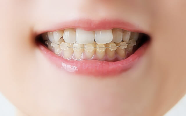 前歯のねじれは部分矯正だけでも直る？