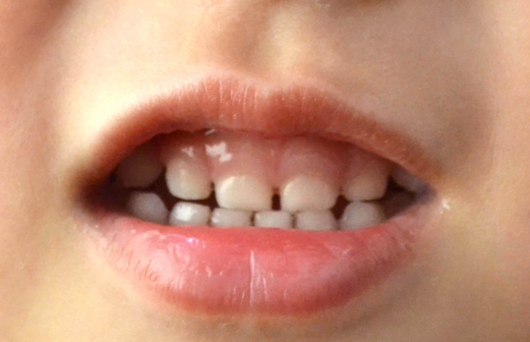 乳歯の時期は歯と歯の間に隙間が空いているのが理想的
