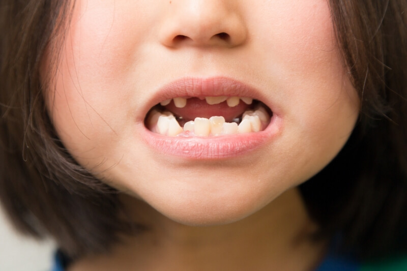 歯並びはどうして悪くなるの？４つの原因