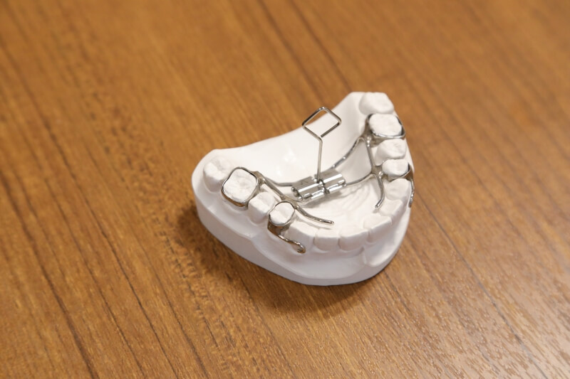 固定式の矯正装置「急速拡大装置」とは