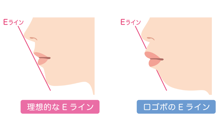 口ゴボ（ゴボ口）とは